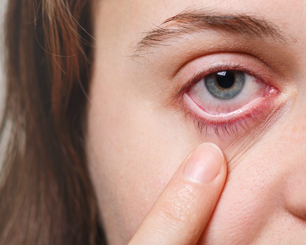 Medicine, health care and eyesight concept. Unrecognizable female shows her inflated red eye with blood capillary, has conjuctivitis. Woman with injured eye